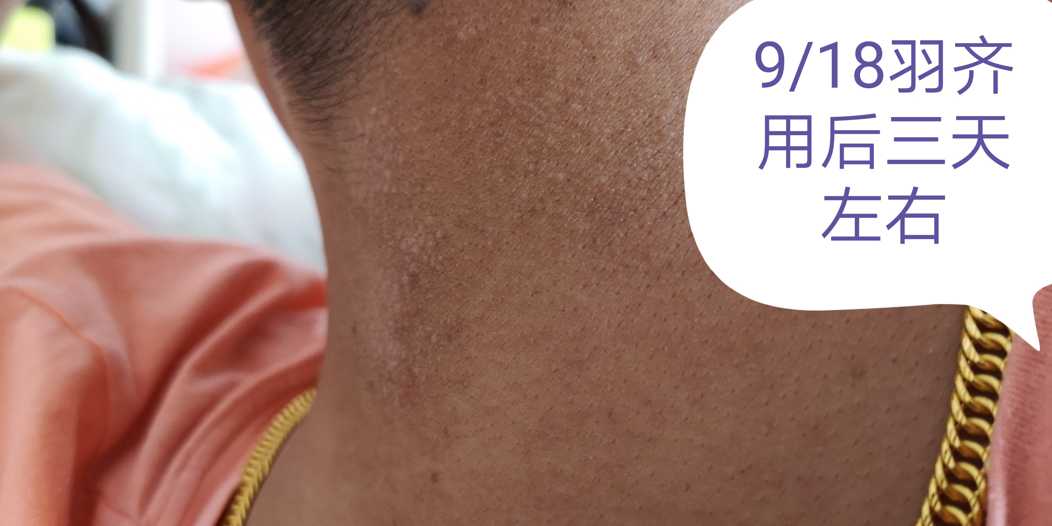 汗斑 (變色糠疹, Pityriasis or Tinea versicolor) – 肌膚親清—陳文國醫師的5分鐘皮膚專欄